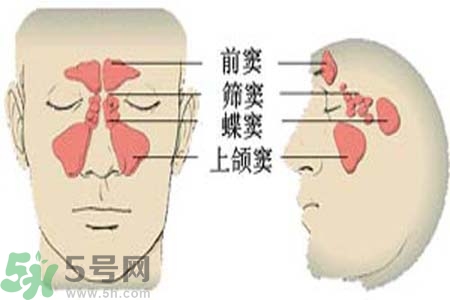 鼻竇炎是什么？鼻竇炎的癥狀有哪些？