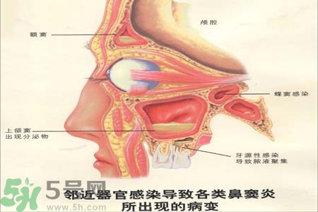 鼻竇炎是什么？鼻竇炎的癥狀有哪些？