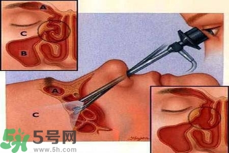 鼻竇炎的高發(fā)人群？如何預(yù)防鼻竇炎？