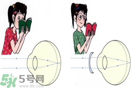 近視眼的發(fā)病因素？近視眼的并發(fā)癥有哪些？