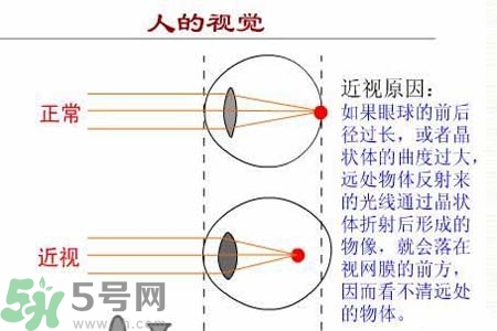 近視眼高發(fā)人群？如何預防近視眼？