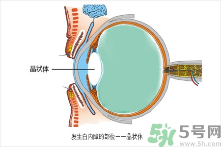 白內(nèi)障的護理措施是什么？白內(nèi)障的飲食護理有哪些？