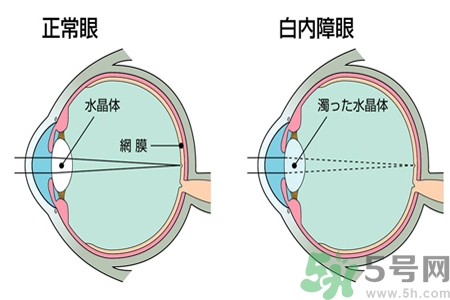 白內(nèi)障的發(fā)病因素是什么？白內(nèi)障并發(fā)癥有哪些？