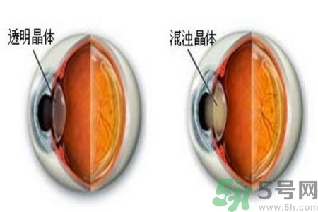 白內(nèi)障治療方法是什么？白內(nèi)障可以用什么藥物治療？