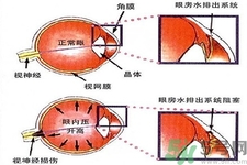 青光眼的發(fā)病因素是什么？青光眼的并發(fā)癥有哪些？