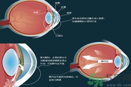 青光眼的高發(fā)人群有哪些？如何預(yù)防青光眼？
