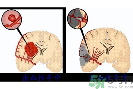 腦出血的發(fā)病因素是什么？腦出血的并發(fā)癥有哪些？