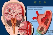 腦出血的發(fā)病因素是什么？腦出血的并發(fā)癥有哪些？
