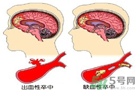 腦出血的治療方法是什么？腦出血可以用哪些藥物治療？