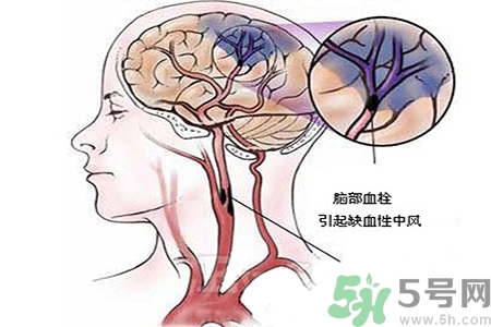腦出血的治療方法是什么？腦出血可以用哪些藥物治療？