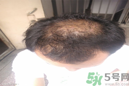 脫發(fā)的措施有什么？脫發(fā)的注意飲食有哪些？