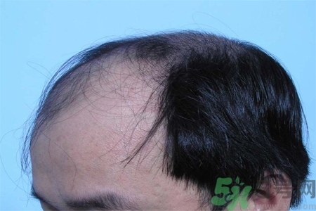 脫發(fā)的措施有什么？脫發(fā)的注意飲食有哪些？