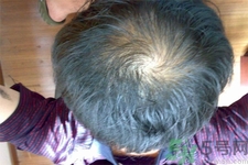 脫發(fā)的高發(fā)人群有哪些？如何預(yù)防脫發(fā)？