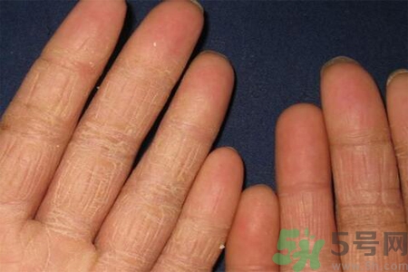 手足癬的治療方法？治療手足癬可以用什么藥？