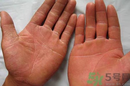 手足癬的治療方法？治療手足癬可以用什么藥？