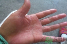 手足癬的易發(fā)人群有哪些？如何預(yù)防手足癬？