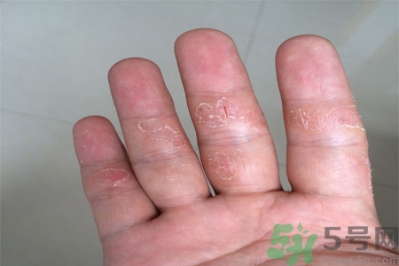 手足癬的易發(fā)人群有哪些？如何預(yù)防手足癬？