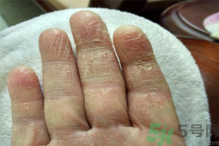 手足癬會傳染嗎？手足癬的傳播途徑有哪些？
