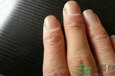 手足癬會傳染嗎？手足癬的傳播途徑有哪些？