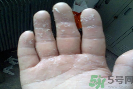手足癬的易發(fā)人群有哪些？如何預(yù)防手足癬？