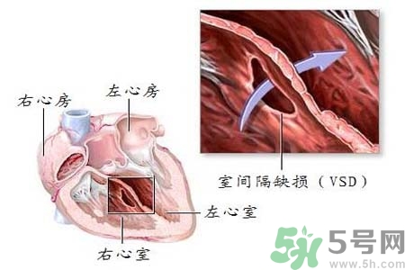心臟病是怎么形成的？易發(fā)人群有哪些？