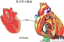 心臟病的癥狀是什么？心臟病的種類有哪些？