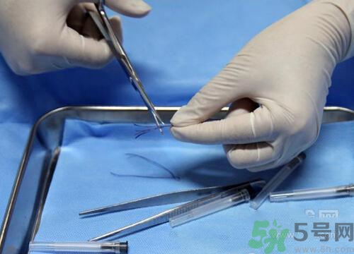 埋線減肥多少錢一次？埋線減肥的副作用