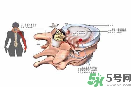 為什么年輕人容易得頸椎??？頸椎病嚴(yán)重的癥狀有哪些？