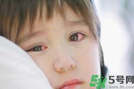 寶寶為什么會感染紅眼病？寶寶患紅眼病如何治療？