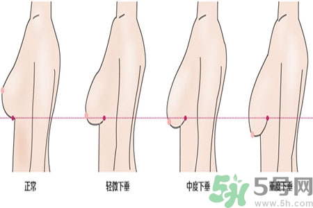 ?女性乳房下垂的原因是什么？女性乳房下垂的分類有哪些？
