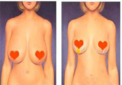 ?女性乳房下垂的原因是什么？女性乳房下垂的分類有哪些？