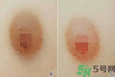 乳頭發(fā)黑怎么辦？怎么樣可以使乳頭變白？