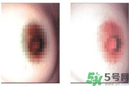 乳頭發(fā)黑怎么辦？怎么樣可以使乳頭變白？