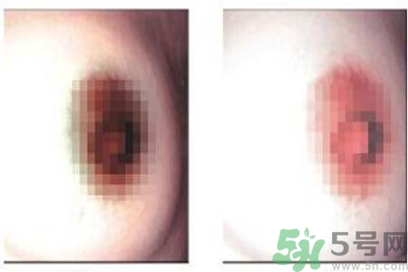 乳頭發(fā)黑是怎么回事？乳頭發(fā)黑是什么原因？