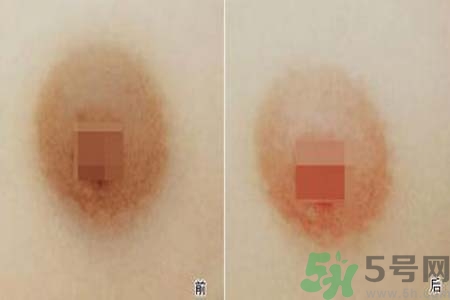 乳頭發(fā)黑是怎么回事？乳頭發(fā)黑是什么原因？