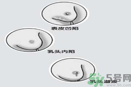 乳頭內(nèi)陷怎么回事？乳頭內(nèi)陷的原因是什么？