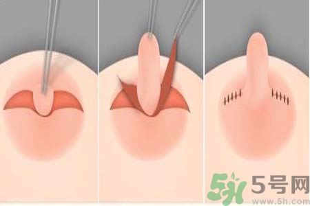乳頭內(nèi)陷怎么回事？乳頭內(nèi)陷的原因是什么？