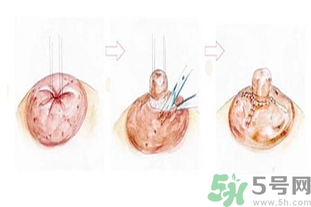 乳頭內(nèi)陷怎么回事？乳頭內(nèi)陷的原因是什么？