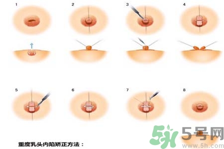 乳頭內(nèi)陷怎么回事？乳頭內(nèi)陷的原因是什么？