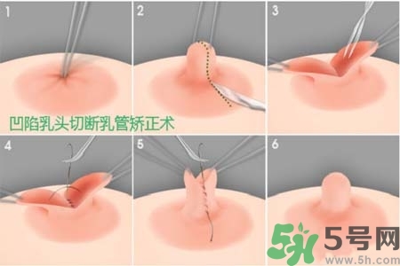 乳頭內(nèi)陷怎么辦？乳頭內(nèi)陷的癥狀有哪些？