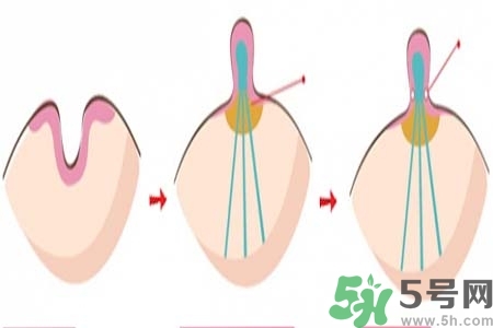 乳頭內(nèi)陷怎么辦？乳頭內(nèi)陷的癥狀有哪些？
