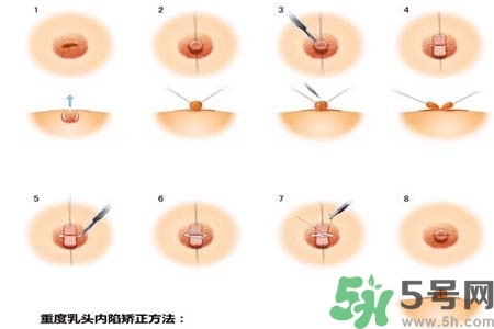 乳頭內(nèi)陷怎么辦？乳頭內(nèi)陷的癥狀有哪些？
