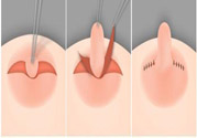 乳頭內(nèi)陷怎么辦？乳頭內(nèi)陷的癥狀有哪些？