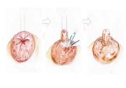 乳頭內(nèi)陷矯正需注意什么？乳頭內(nèi)陷如何預(yù)防？