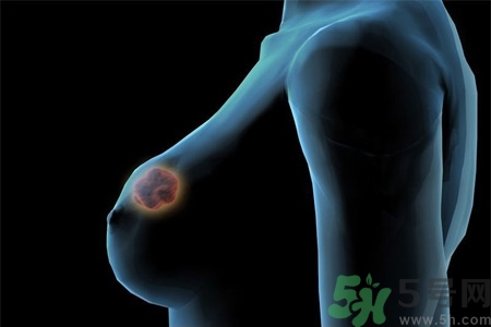 乳房屋硬塊有疼痛感怎么回事？乳房屋硬塊有疼痛感怎么辦？