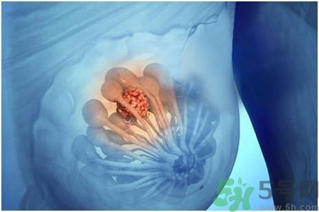 乳房屋硬塊有疼痛感怎么回事？乳房屋硬塊有疼痛感怎么辦？