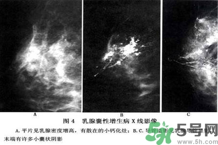 產(chǎn)生乳腺增生鈣化的病因是什么？乳腺增生怎樣治療？
