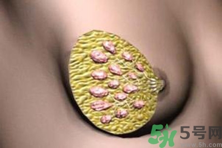 乳腺增生鈣化是什么？乳腺鈣化的癥狀有哪些？