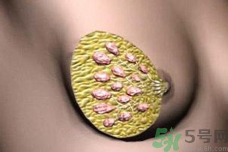 產(chǎn)生乳腺增生鈣化的病因是什么？乳腺增生怎樣治療？