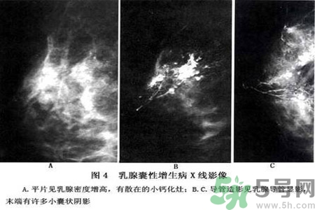 乳腺增生鈣化是什么？乳腺鈣化的癥狀有哪些？